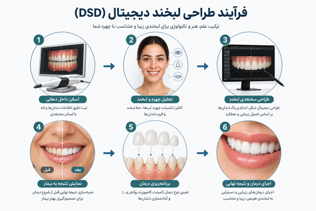 دیاگرام نمادین مراحل طراحی لبخند دیجیتال (DSD) شامل اسکن داخل دهانی، تحلیل چهره، طراحی سهبعدی و اجرای درمان